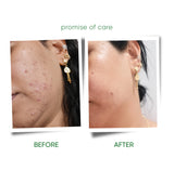 HENZOCARE FOAMING FACEWASH | 100ml