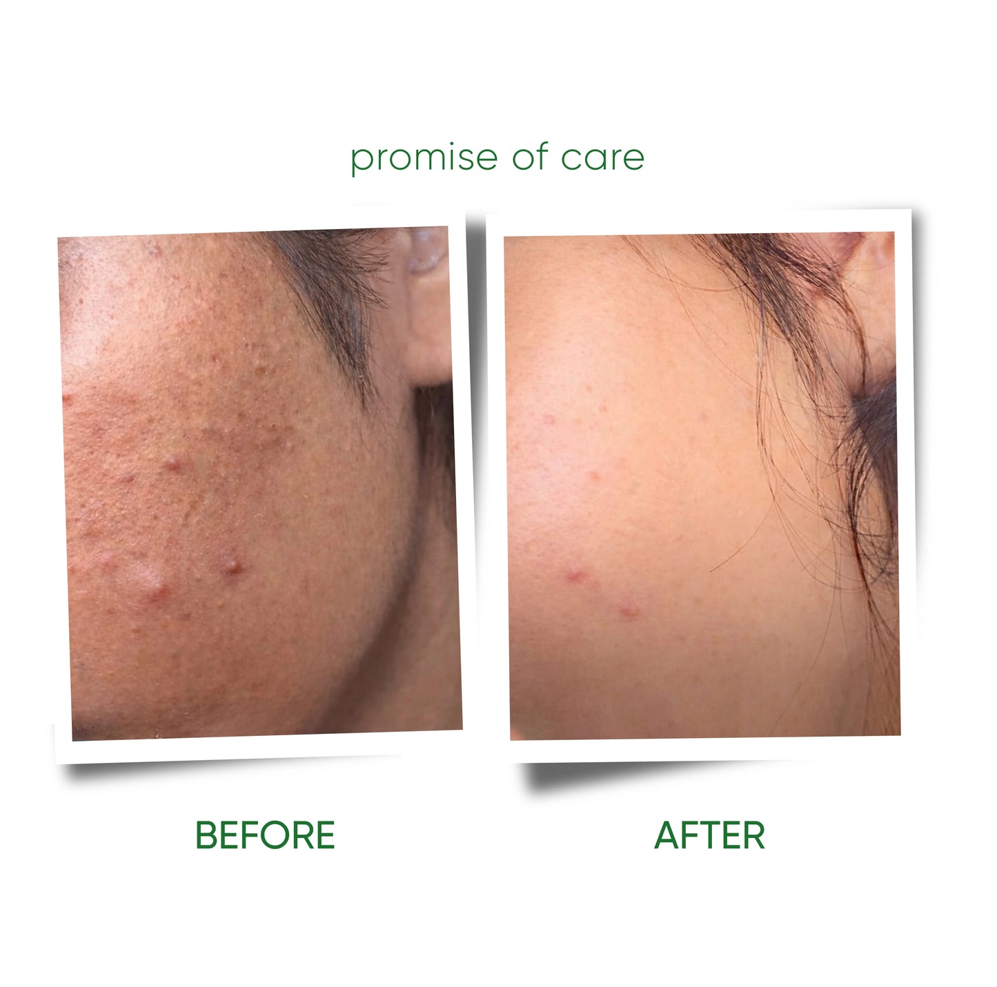HENZOCARE FOAMING FACEWASH | 100ml